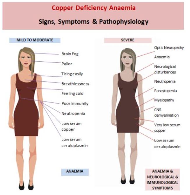 Copper Deficiency Anaemia